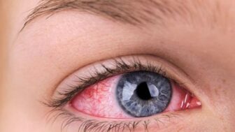 Göz Kızarıklığı, Göz Kanlanmasının Sebepleri Belirtileri Tedavisi
